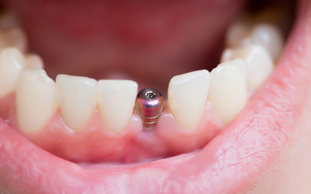 Dental Implant Repair Cost: How Laser Welding Helps You Save Money