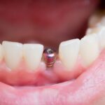 Dental Implant Repair Cost: How Laser Welding Helps You Save Money 6 Dental Implant Repair Cost: How Laser Welding Helps You Save Money